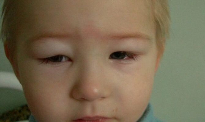 Ознаки нефротичного синдрому: як розпізнати та зрозуміти симптоми