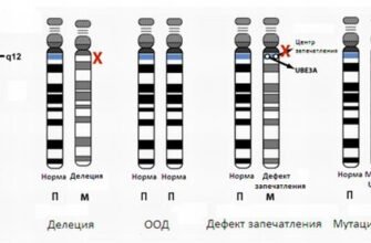 Ознаки синдрому Олбрайта: повний огляд симптомів та діагностики