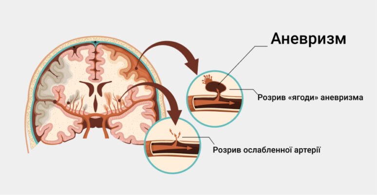 Що таке аневризма: причини, симптоми та методи лікування
