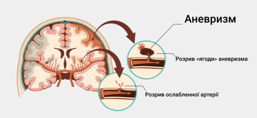Що таке аневризма: причини, симптоми та методи лікування