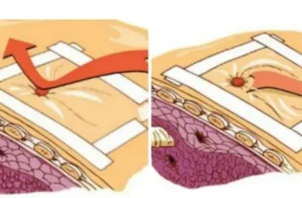 Як самостійно зробити оклюзійну пов’язку: покрокова інструкція