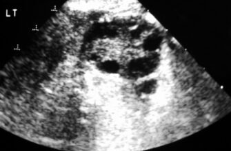 Симптоми синдрому полікістозних яєчників: ознаки та діагностика المشكلة