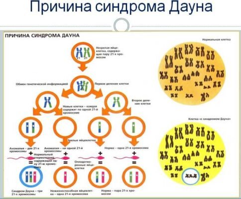 Синдром Дауна у немовлят: ознаки, діагностика та підтримка батьків Синдром Дауна у немовлят: ознаки, діагностика та підтримка батьків