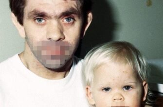 Синдром Джоба: Симптоми, Діагностика та Лікування Генетичного Розладу