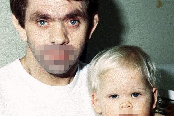 Синдром Джоба: Симптоми, Діагностика та Лікування Генетичного Розладу