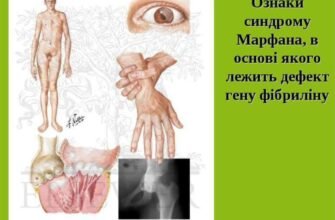 Синдром Марфана: фото людей з цим генетичним захворюванням