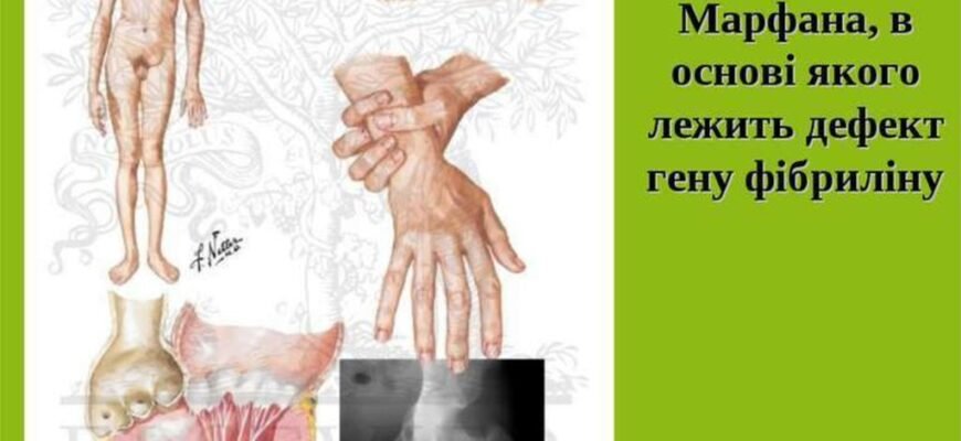 Синдром Марфана: фото людей з цим генетичним захворюванням