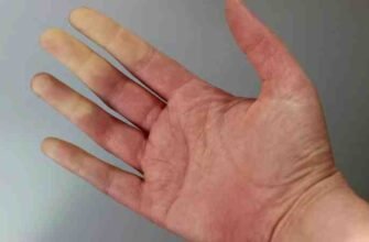 Синдром Рейно при ВКВ: причини, симптоми та ефективність лікування