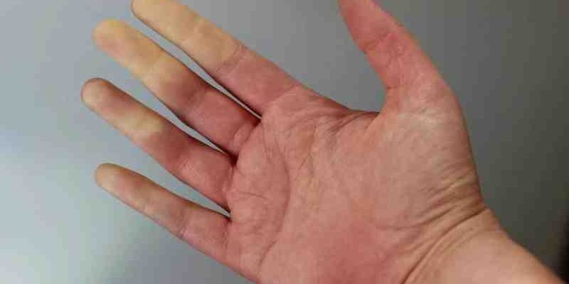 Синдром Рейно при ВКВ: причини, симптоми та ефективність лікування