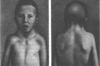 Синдром Шерешевського: Симптоми, Діагностика та Сучасне Лікування