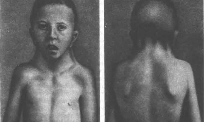 Синдром Шерешевського: Симптоми, Діагностика та Сучасне Лікування