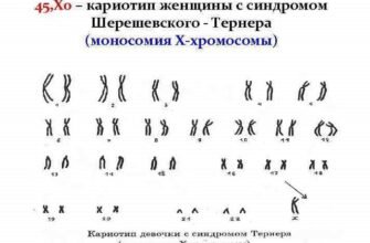 Синдром Шерешевського-Тернера: причини, симптоми та діагностика розладу