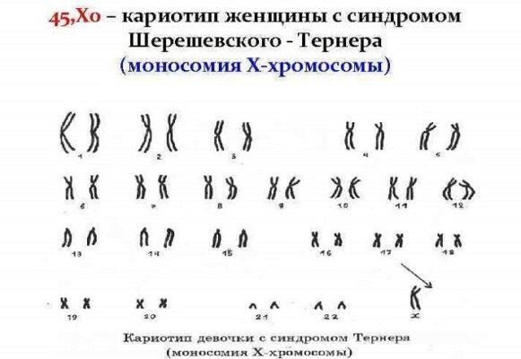 Синдром Шерешевського-Тернера: причини, симптоми та діагностика розладу