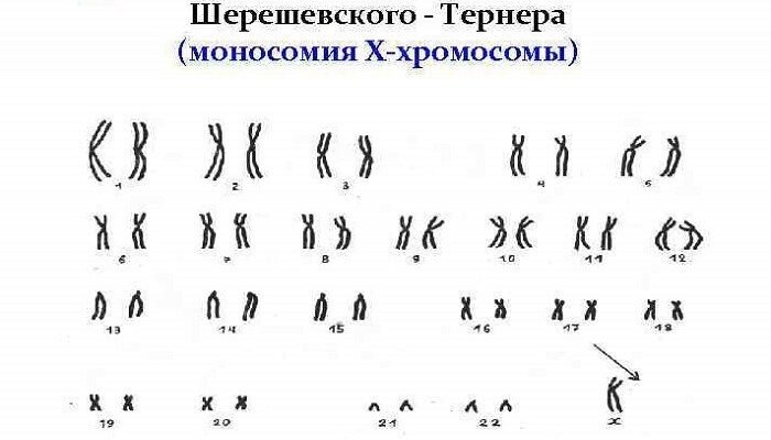 Синдром Шерешевського-Тернера: причини, симптоми та діагностика розладу