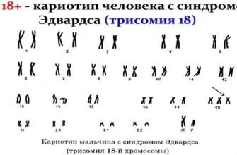 Синдром Тернера: Основні Симптоми та Ознаки Ураження