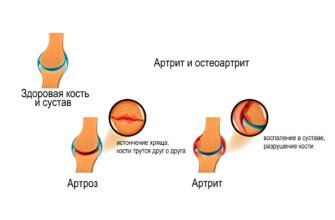 Артропатії: симптоми, діагностика та ефективні методи лікування