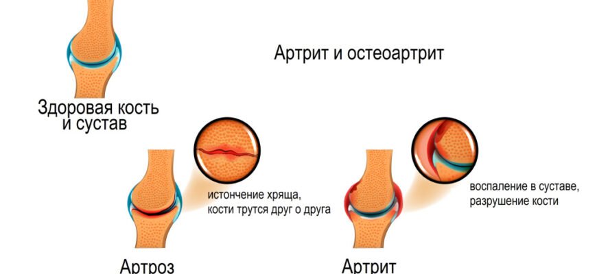 Артропатії: симптоми, діагностика та ефективні методи лікування